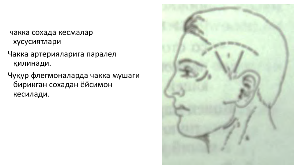 чакка сохада кесмалар
хусусиятлари
Чакка артерияларига паралел 
қилинади.
Чуқур флегмоналарда чакка мушаги
бирикган сохадан ёйсимон
кесилади.
