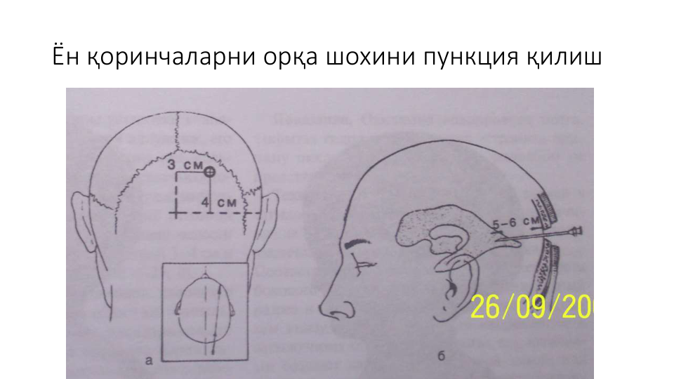 Ён қоринчаларни орқа шохини пункция қилиш
