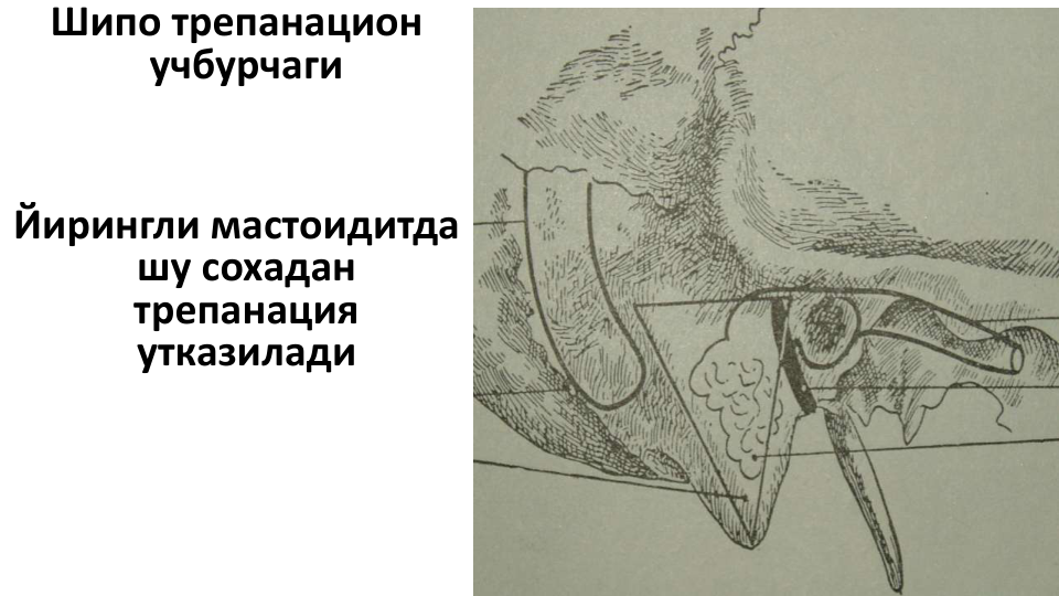 Шипо трепанацион
учбурчаги
Йирингли мастоидитда 
шу сохадан 
трепанация 
утказилади
