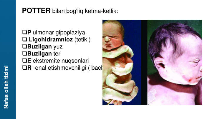 Nafas olish tizimi
POTTER bilan bog'liq ketma-ketlik:
P ulmonar gipoplaziya
Ligohidramnioz (tetik )
Buzilgan yuz
Buzilgan teri
E ekstremite nuqsonlari
R -enal etishmovchiligi ( bachadonda )
